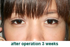 plastic-surgery-blepharoplasty